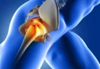 osteoarthritis hip