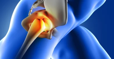 osteoarthritis hip