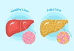 Fatty Liver Diet