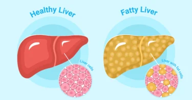Fatty Liver Diet