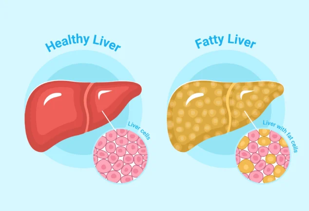 Fatty Liver Diet