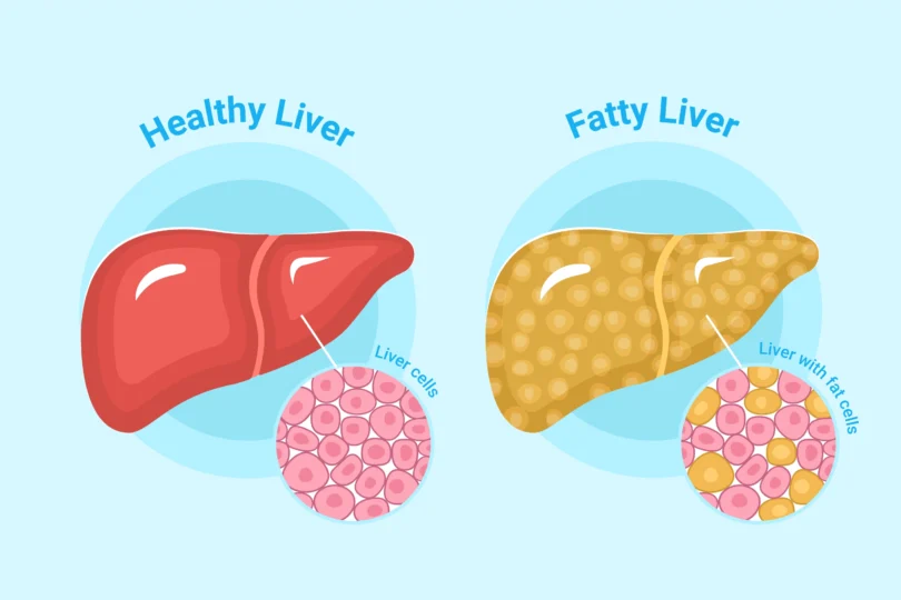 Fatty Liver Diet