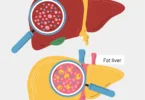 MASLD Treatment