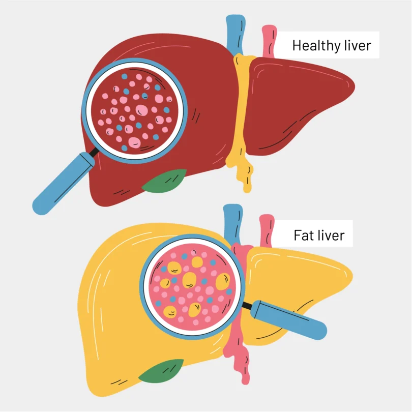 MASLD Treatment